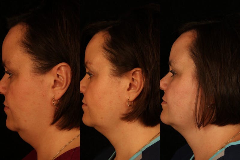 Kybella Before & After Gallery - Patient 37499575 - Image 1