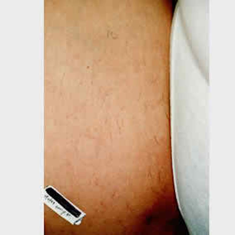 Laser Hair Removal Before & After Gallery - Patient 37499565 - Image 2