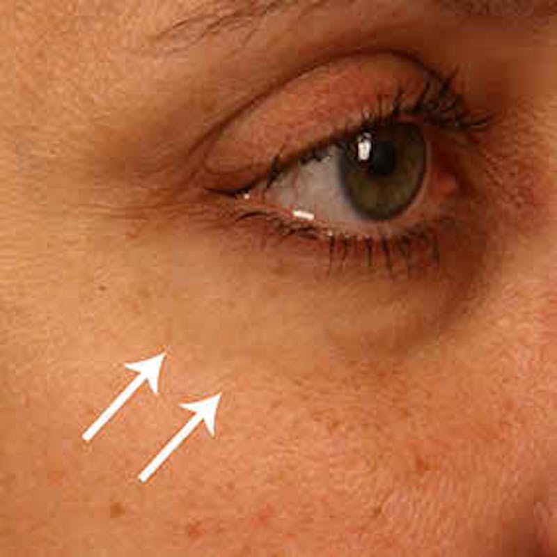 Facial Veins/Vascular Lesions Before & After Gallery - Patient 37499569 - Image 2