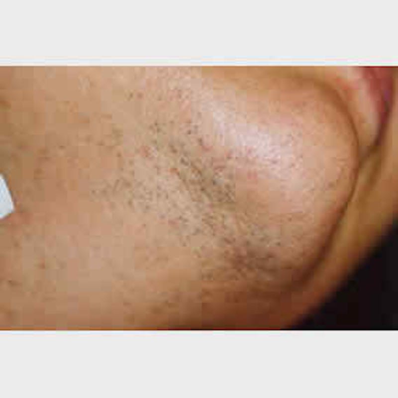 Laser Hair Removal Before & After Gallery - Patient 37499578 - Image 1