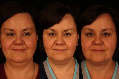 Kybella Before & After Gallery - Patient 37499575 - Image 2