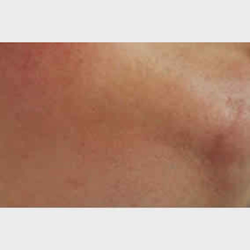 Laser Hair Removal Before & After Gallery - Patient 37499578 - Image 2