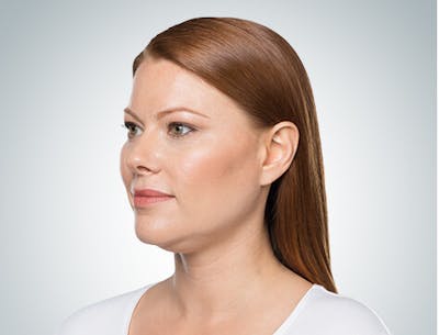 Kybella Before & After Gallery - Patient 37499585 - Image 1