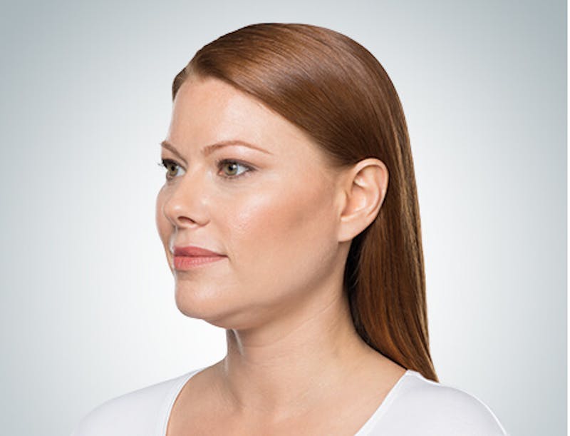 Kybella Before & After Gallery - Patient 37499585 - Image 1