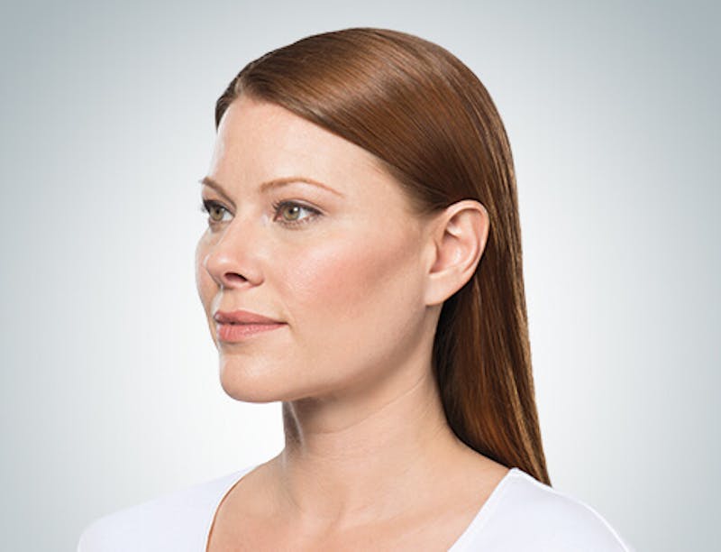 Kybella Before & After Gallery - Patient 37499585 - Image 2