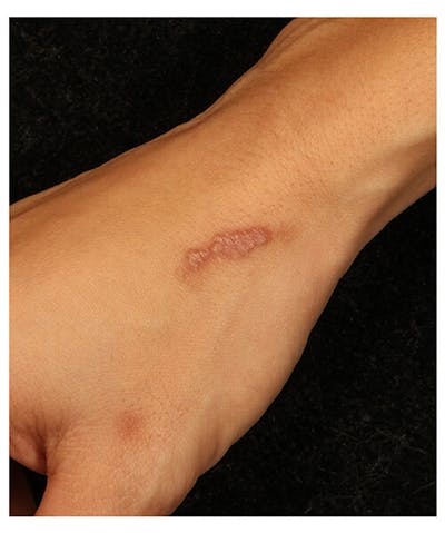 Laser Scar Treatments Before & After Gallery - Patient 37499606 - Image 1