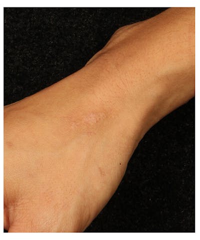 Laser Scar Treatments Before & After Gallery - Patient 37499606 - Image 2