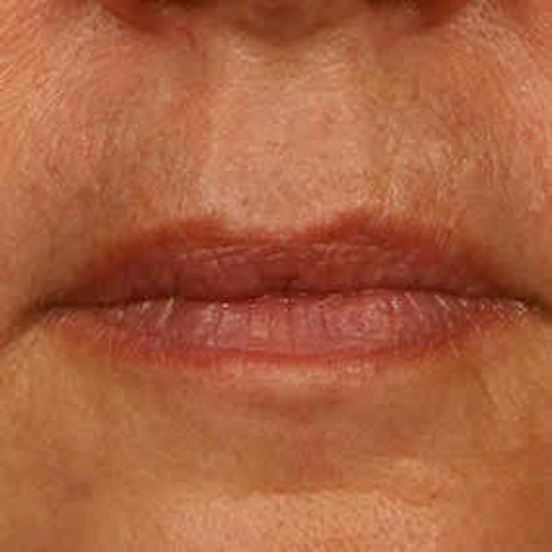 Facial Veins/Vascular Lesions Before & After Gallery - Patient 37499616 - Image 1