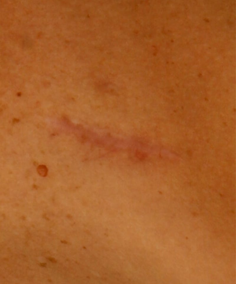 Laser Scar Treatments Before & After Gallery - Patient 37499618 - Image 1