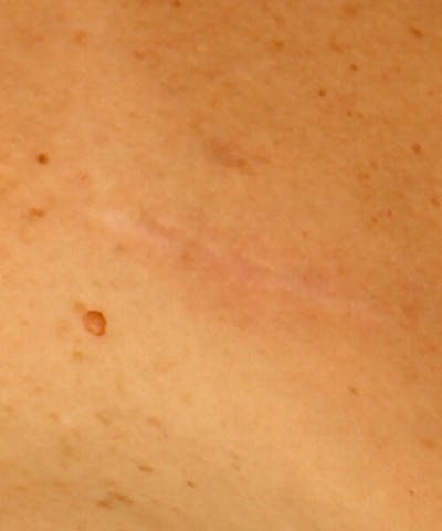 Laser Scar Treatments Before & After Gallery - Patient 37499618 - Image 2