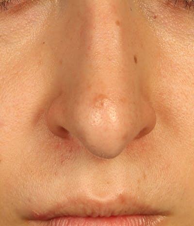 Mole Removal Before & After Gallery - Patient 37499626 - Image 1