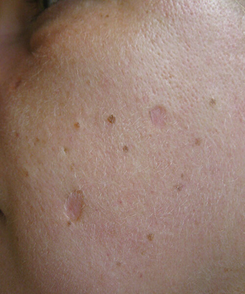 Laser Scar Treatments Before & After Gallery - Patient 37499653 - Image 1