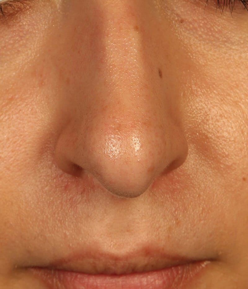 Mole Removal Before & After Gallery - Patient 37499626 - Image 2