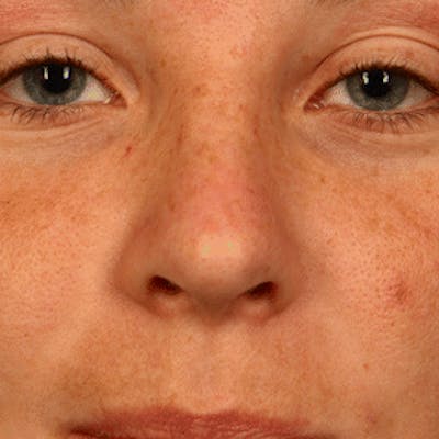 Facial Veins/Vascular Lesions Before & After Gallery - Patient 37499627 - Image 2