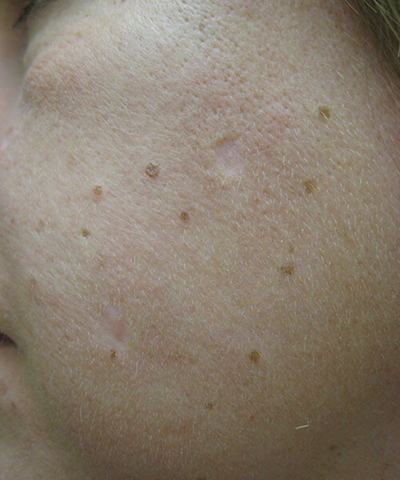 Laser Scar Treatments Before & After Gallery - Patient 37499653 - Image 2