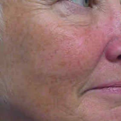 Photofacial Intense Pulsed Light Before & After Gallery - Patient 37499658 - Image 1