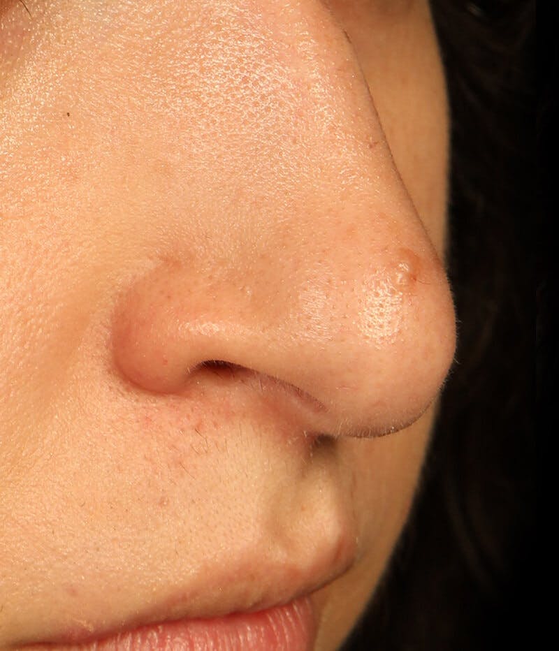 Mole Removal Before & After Gallery - Patient 37499660 - Image 1