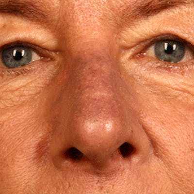 Facial Veins/Vascular Lesions Before & After Gallery - Patient 37499661 - Image 1