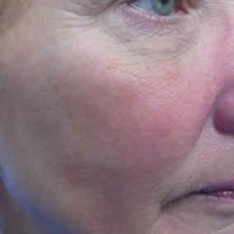 Photofacial Intense Pulsed Light Before & After Gallery - Patient 37499658 - Image 2