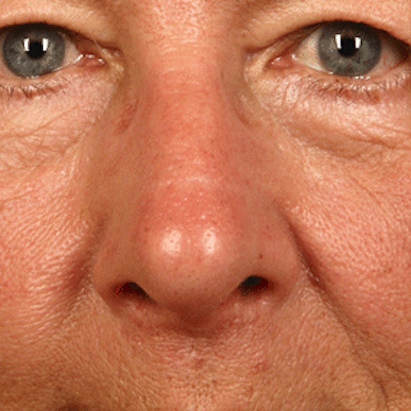 Facial Veins/Vascular Lesions Before & After Gallery - Patient 37499661 - Image 2
