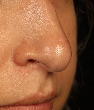 Mole Removal Before & After Gallery - Patient 37499660 - Image 2