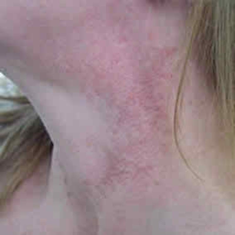 Photofacial Intense Pulsed Light Before & After Gallery - Patient 37499666 - Image 1