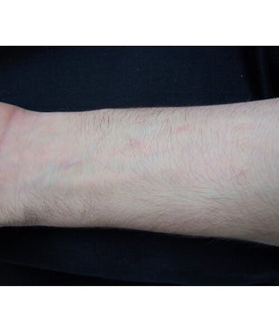 Laser Scar Treatments Before & After Gallery - Patient 37499663 - Image 2
