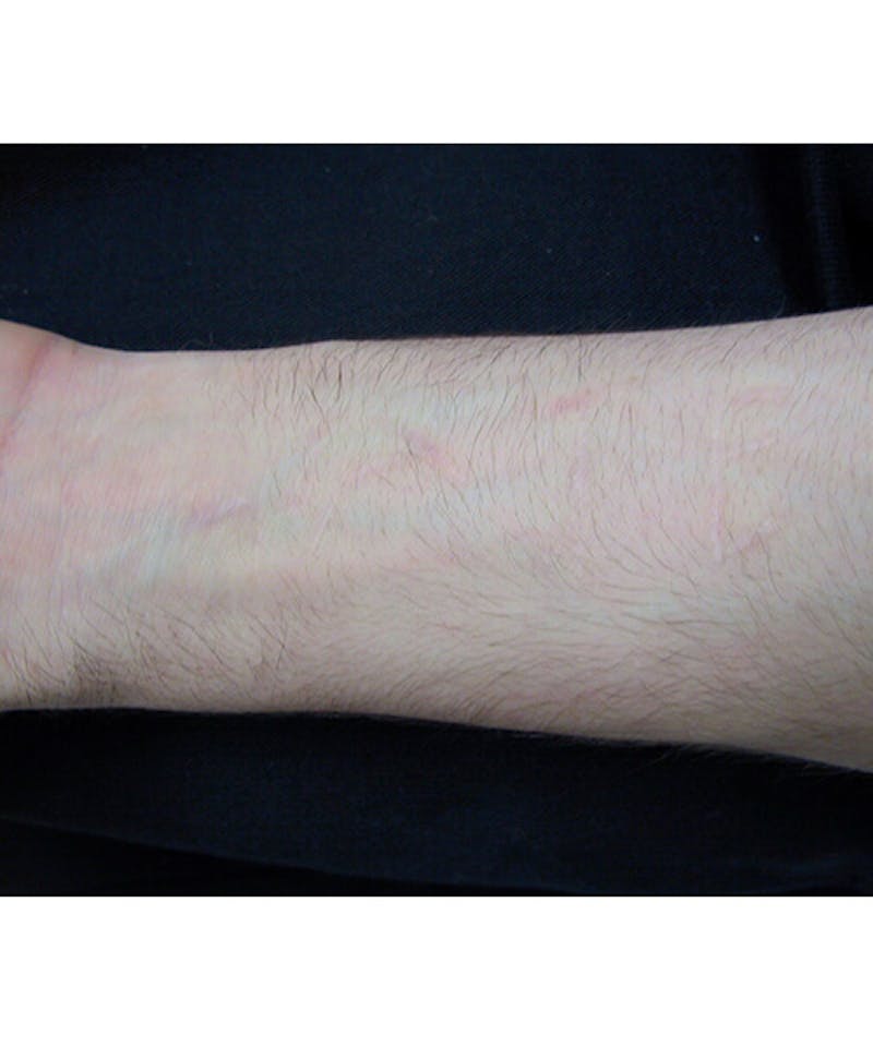 Laser Scar Treatments Before & After Gallery - Patient 37499663 - Image 2