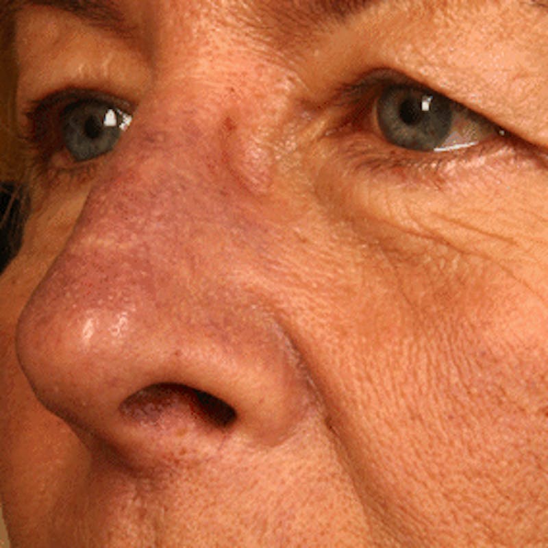 Facial Veins/Vascular Lesions Before & After Gallery - Patient 37499661 - Image 3