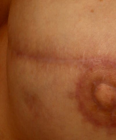 Laser Scar Treatments Before & After Gallery - Patient 37499673 - Image 1