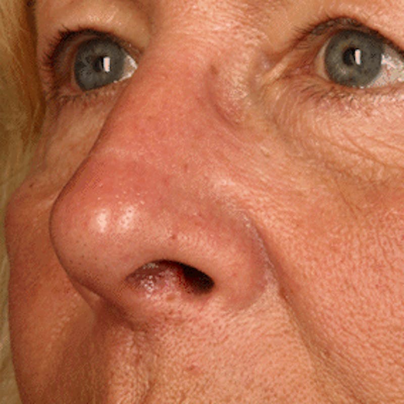 Facial Veins/Vascular Lesions Before & After Gallery - Patient 37499661 - Image 4