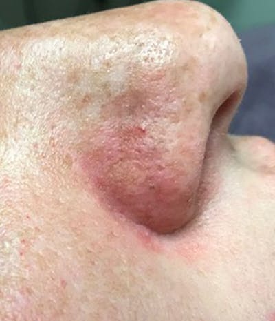 Mole Removal Before & After Gallery - Patient 37499670 - Image 2