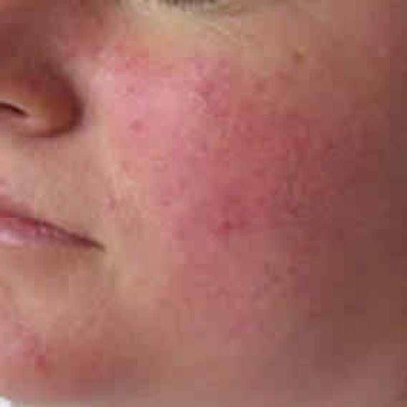 Photofacial Intense Pulsed Light Before & After Gallery - Patient 37499675 - Image 1