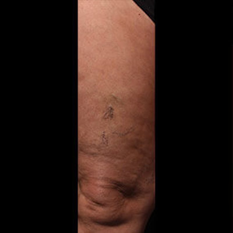 Spider Veins Before & After Gallery - Patient 37499678 - Image 1
