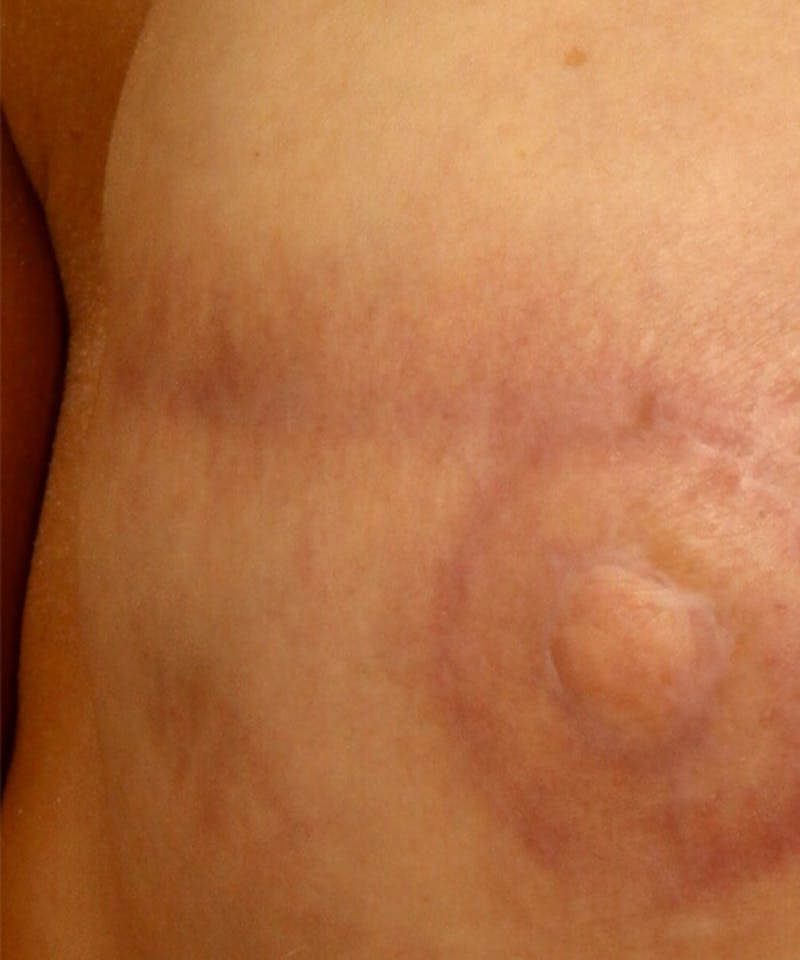 Laser Scar Treatments Before & After Gallery - Patient 37499673 - Image 2