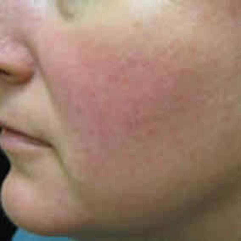 Photofacial Intense Pulsed Light Before & After Gallery - Patient 37499675 - Image 2