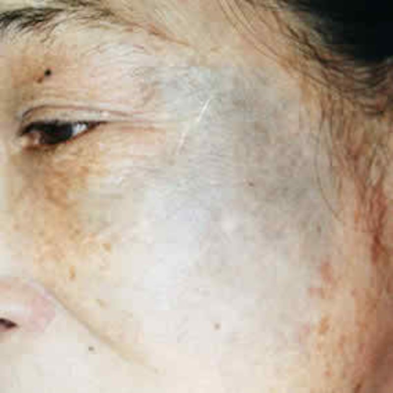Pigmented Lesion Laser Treatment Before & After Gallery - Patient 37499677 - Image 2