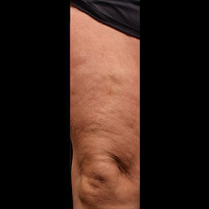Spider Veins Before & After Gallery - Patient 37499678 - Image 2
