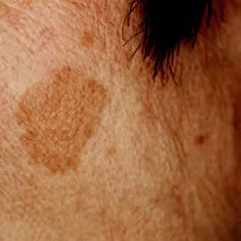 Pigmented Lesion Laser Treatment Before & After Gallery - Patient 37499684 - Image 1
