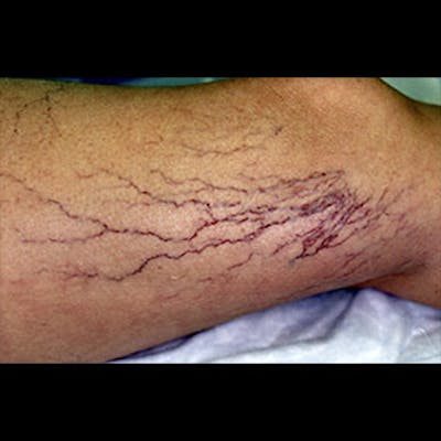 Spider Veins Before & After Gallery - Patient 37499685 - Image 1
