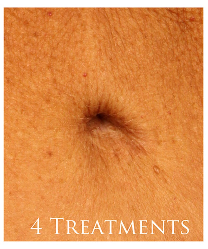 Laser Scar Treatments Before & After Gallery - Patient 37499683 - Image 2