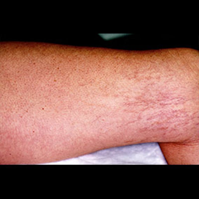 Spider Veins Before & After Gallery - Patient 37499685 - Image 2