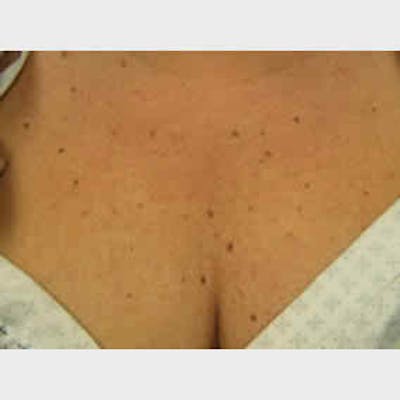 Pigmented Lesion Laser Treatment Before & After Gallery - Patient 37499690 - Image 1