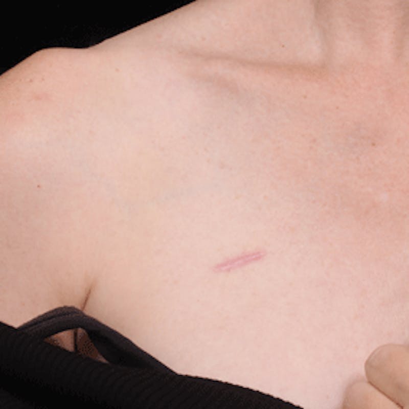 Laser Scar Treatments Before & After Gallery - Patient 37499691 - Image 1