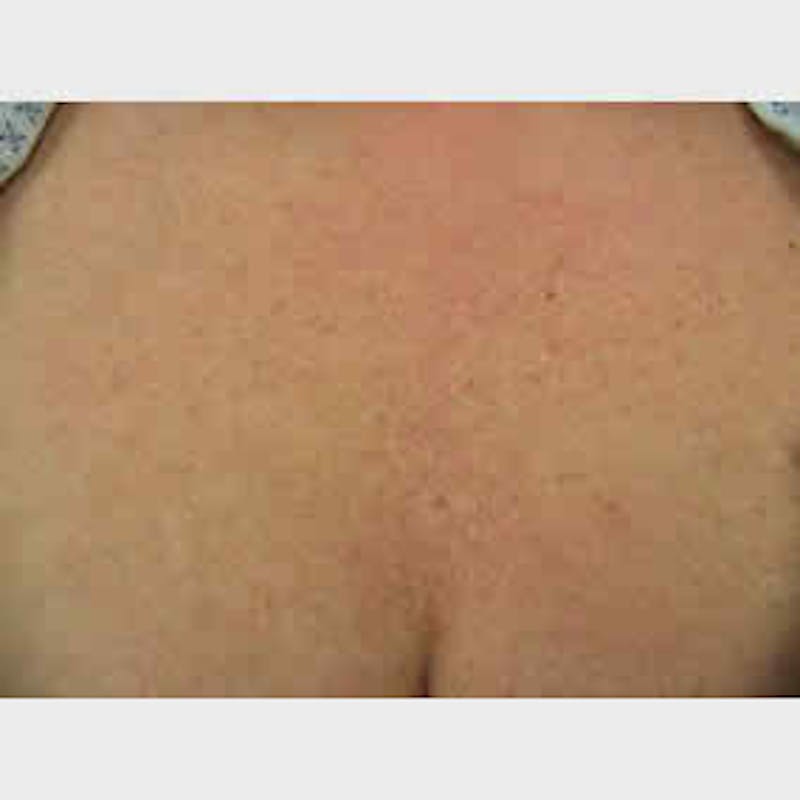 Pigmented Lesion Laser Treatment Before & After Gallery - Patient 37499690 - Image 2