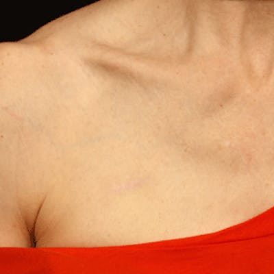 Laser Scar Treatments Before & After Gallery - Patient 37499691 - Image 2