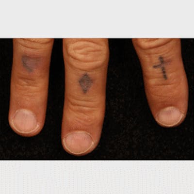 Laser Tattoo Removal Before & After Gallery - Patient 37499698 - Image 1