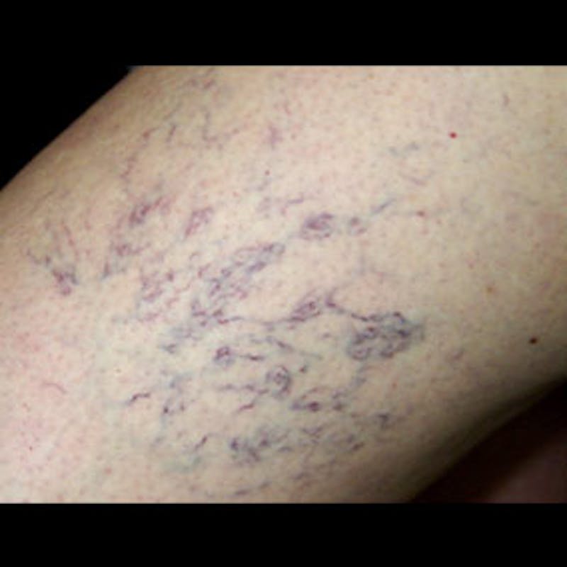 Spider Veins Before & After Gallery - Patient 37499700 - Image 1
