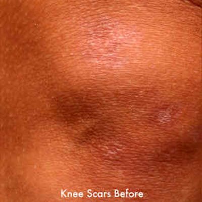 Laser Scar Treatments Before & After Gallery - Patient 37499701 - Image 1