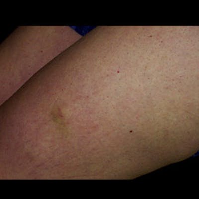 Spider Veins Before & After Gallery - Patient 37499700 - Image 2
